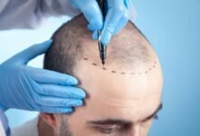مركز زراعة الشعر التركي (Hair of Istanbul) حالياً في دبي مركز زراعة الشعر التركي (Hair of Istanbul) حالياً في دبي