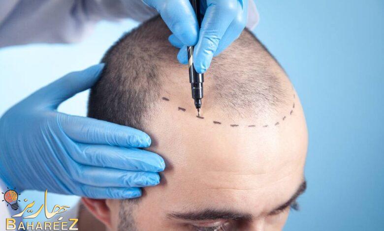 مركز زراعة الشعر التركي (Hair of Istanbul) حالياً في دبي مركز زراعة الشعر التركي (Hair of Istanbul) حالياً في دبي