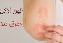 ما هو سبب ظهور الاكزيما؟ وما هي أنواعها وطرق علاجها؟