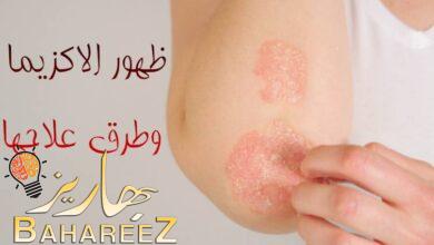 ما هو سبب ظهور الاكزيما؟ وما هي أنواعها وطرق علاجها؟ ما هو سبب ظهور الاكزيما؟ وما هي أنواعها وطرق علاجها؟