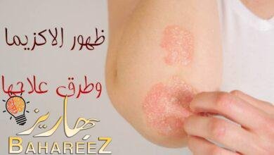 ما هو سبب ظهور الاكزيما؟ وما هي أنواعها وطرق علاجها؟ ما هو سبب ظهور الاكزيما؟ وما هي أنواعها وطرق علاجها؟