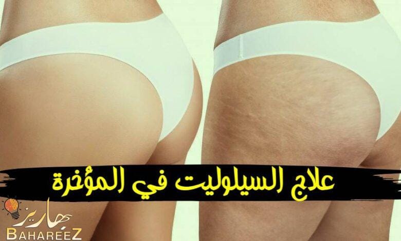 طرق علاج السيلوليت في المؤخرة واهم اسبابها طرق علاج السيلوليت في المؤخرة واهم اسبابها